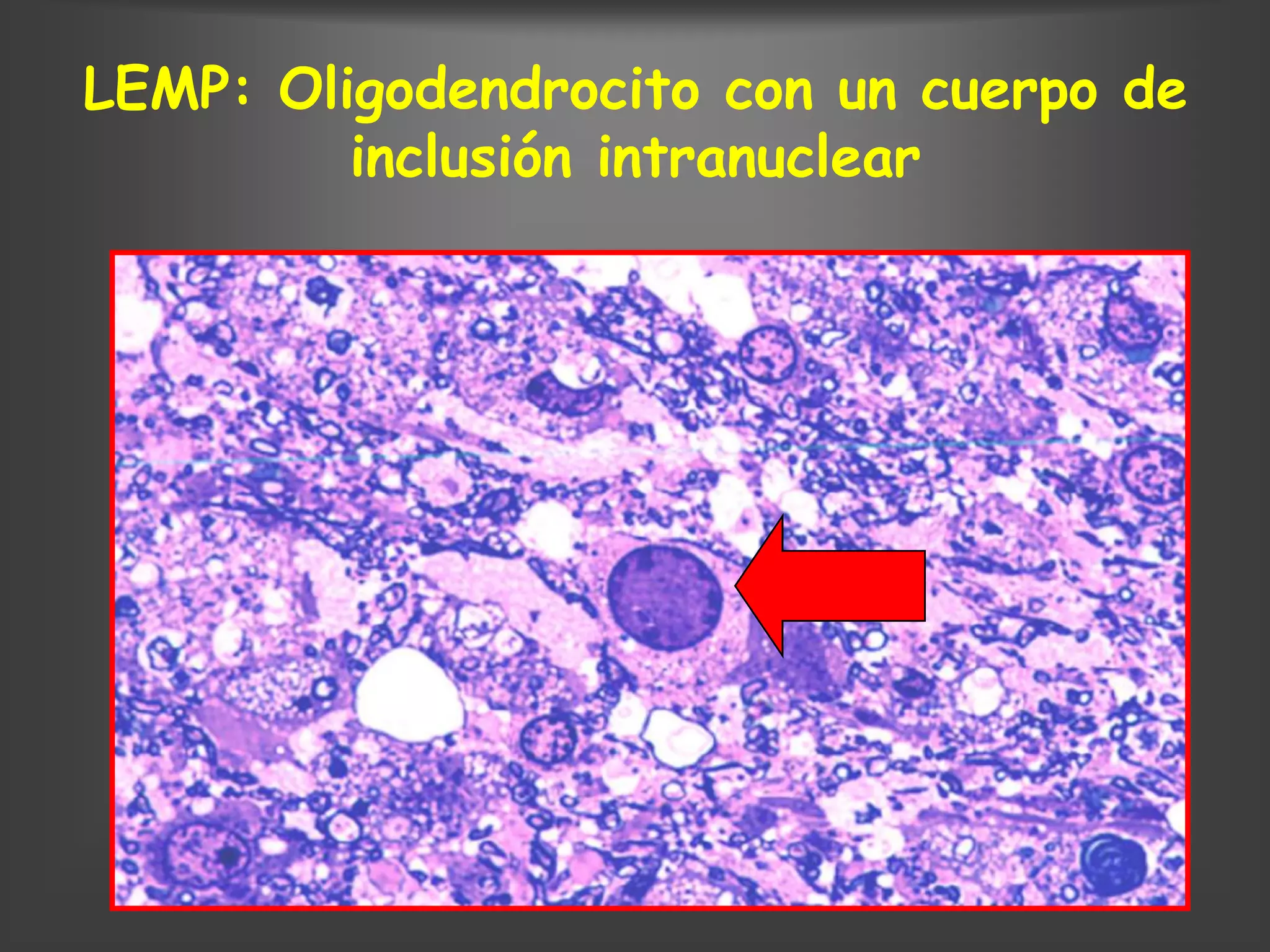 LEMP: Oligodendrocito con un cuerpo de
         inclusión intranuclear
 