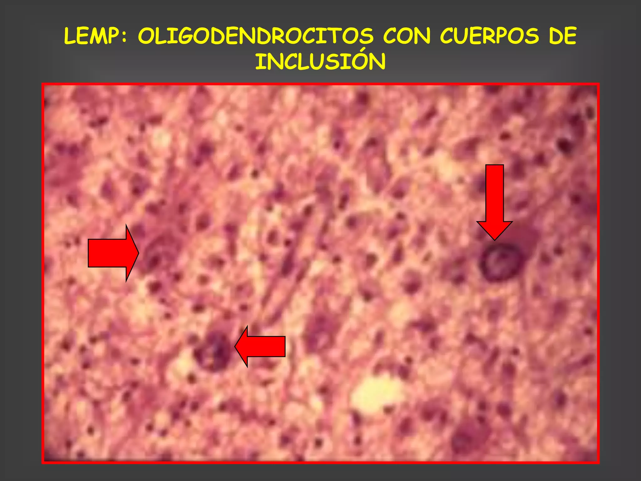LEMP: OLIGODENDROCITOS CON CUERPOS DE
              INCLUSIÓN
 