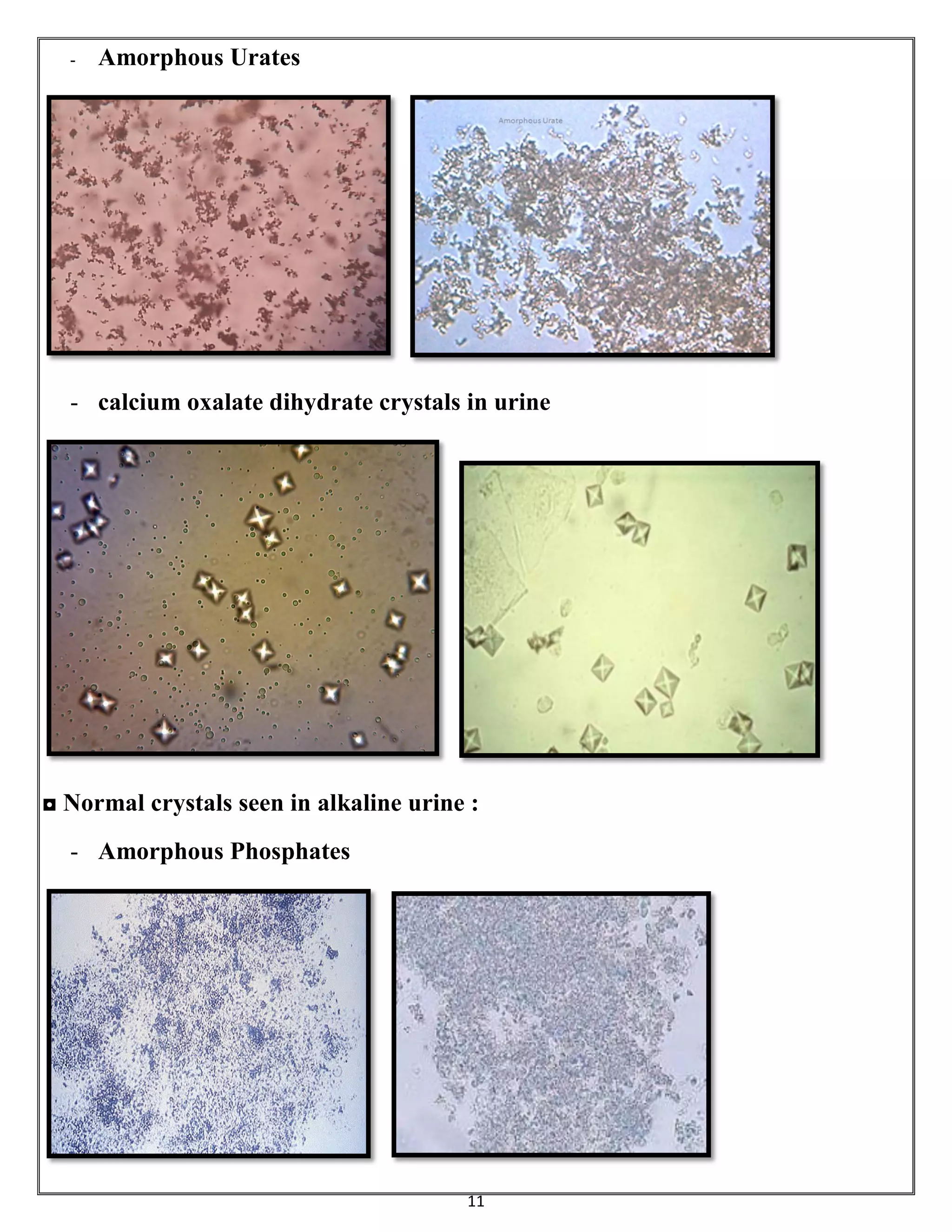 Amorphous Urates In Urine