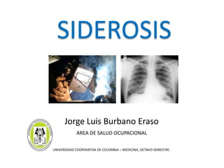 SIDEROSIS


      Jorge Luis Burbano Eraso
            AREA DE SALUD OCUPACIONAL

UNIVERSIDAD COOPERATIVA DE COLOMBIA – MEDICINA, OCTAVO SEMESTRE.
 