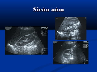 Sieâu aâmSieâu aâm
 