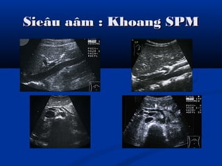 Sieâu aâm : Khoang SPMSieâu aâm : Khoang SPM
 