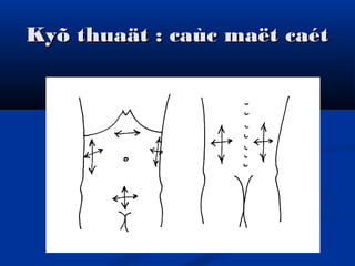 Kyõ thuaät : caùc maët caétKyõ thuaät : caùc maët caét
 