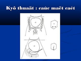 Kyõ thuaät : caùc maët caétKyõ thuaät : caùc maët caét
 