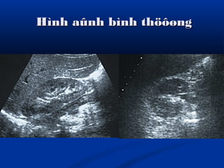 Hình aûnh bình thöôøngHình aûnh bình thöôøng
 