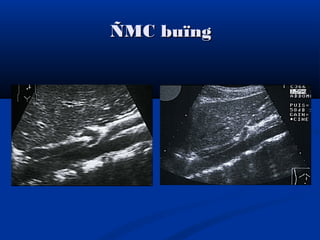 ÑMC buïngÑMC buïng
 