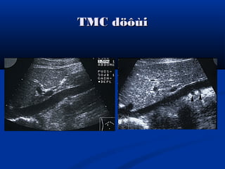 TMC döôùiTMC döôùi
 