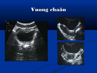 Vuøng chaäuVuøng chaäu
 