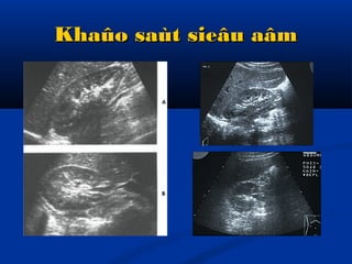 Khaûo saùt sieâu aâmKhaûo saùt sieâu aâm
 