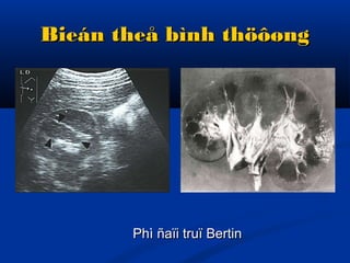 Bieán theå bình thöôøngBieán theå bình thöôøng
Phì ñaïi truï BertinPhì ñaïi truï Bertin
 