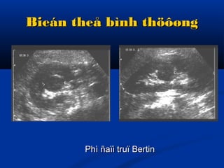 Bieán theå bình thöôøngBieán theå bình thöôøng
Phì ñaïi truï BertinPhì ñaïi truï Bertin
 