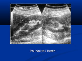 Phì ñaïi truï BertinPhì ñaïi truï Bertin
 