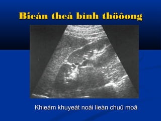 Bieán theå bình thöôøngBieán theå bình thöôøng
Khieám khuyeát noái lieàn chuû moâKhieám khuyeát noái lieàn chuû moâ
 