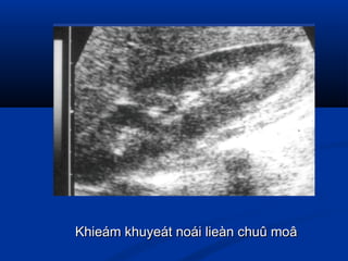 Khieám khuyeát noái lieàn chuû moâKhieám khuyeát noái lieàn chuû moâ
 