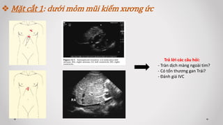 Mặt cắt 1: dưới mỏm mũi kiếm xương ức
Trả lời các câu hỏi:
- Tràn dịch màng ngoài tim?
- Có tổn thương gan Trái?
- Đánh giá IVC
 