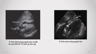  Tràn dịch màng ngoài tim có dấu
đè sụp thất (P)  chèn ép tim cấp
 Tràn máu màng ngoài tim
 