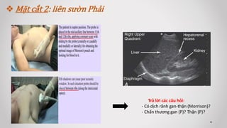  Mặt cắt 2: liên sườn Phải
Trả lời các câu hỏi:
- Có dịch rãnh gan-thận (Morrison)?
- Chấn thương gan (P)? Thận (P)?
 