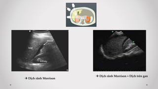  Dịch rãnh Morrison
 Dịch rãnh Morrison + Dịch trên gan
 