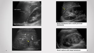 Liver rupture
Hemoperitoneum
Hematoma
Liver rupture
Renal hematoma and a small perirenal
hematoma
Renal rupture with large hematoma
 