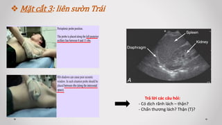  Mặt cắt 3: liên sườn Trái
Trả lời các câu hỏi:
- Có dịch rãnh lách – thận?
- Chấn thương lách? Thận (T)?
 