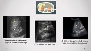  Dịch rãnh lách-thận kèm
dập/nứt lách (mũi tên vàng)
 Dịch tự do cực dưới lách
 Dịch tự do cực trên lách kèm có
máu đông (mũi tên hình thang)
 
