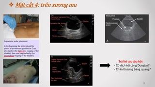  Mặt cắt 4: trên xương mu
Trả lời các câu hỏi:
- Có dịch túi cùng Douglas?
- Chấn thương bàng quang?
 