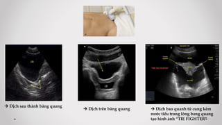  Dịch sau thành bàng quang
 Dịch trên bàng quang  Dịch bao quanh tử cung kèm
nước tiểu trong lòng bang quang
tạo hình ảnh “TIE FIGHTER”
 