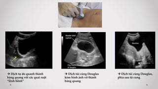  Dịch tự do quanh thành
bàng quang với các quai ruột
“lềnh bềnh”
 Dịch túi cùng Douglas,
phía sau tử cung
Bladder
 Dịch túi cùng Douglas
kèm hình ảnh vỡ thành
bàng quang
 