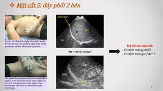  Mặt cắt 5: đáy phổi 2 bên
“MI = Mirror Image”
Trả lời các câu hỏi:
- Có dịch màng phổi?
- Có dịch trên gan/lách?
 