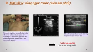  Mặt cắt 6: vùng ngực trước (siêu âm phổi)
Trả lời các câu hỏi:
Có tràn khí màng phổi?
 