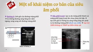  Dấu phổi trượt: tạo ra do màng phổi thành và
màng phổi tạng trượt lên nhau theo hô hấp 
tạo ảnh giả là những tia sáng trắng tăng âm phát
ra từ đường màng phổi (đuôi sao chổi)  loại trừ
100% không có TKMP tại điểm khảo sát
 Đường A: ảnh giả của đường màng phổi
 là những đường sáng tăng âm nằm
ngang, song song với đường màng phổi
Một số khái niệm cơ bản của siêu
âm phổi
 