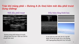 Tràn khí màng phổi = Đường A (A-line) kèm mất dấu phổi trượt
(lung sliding)
Mất dấu phổi trượt
- Đường màng phổi không di chuyển
- Không thấy hình ảnh “đuôi sao chổi”di
chuyển bên dưới
Dấu hiệu tầng bình lưu
Vì các cấu trúc trên siêu âm lúc này bất
động  trên M-mode cho ra các đường
nằm ngang giống tầng bình lưu/ mã vạch
 