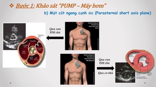 b) Mặt cắt ngang cạnh ức (Parasternal short axis plane)
 Bước 1: Khảo sát “PUMP – Máy bơm”
Qua van
ĐM chủ
Qua van
ĐM chủ
Qua cơ nhú
 