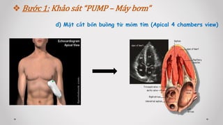 d) Mặt cắt bốn buồng từ mỏm tim (Apical 4 chambers view)
 Bước 1: Khảo sát “PUMP – Máy bơm”
 