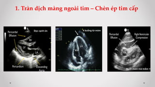 Dưới mỏm mũi kiếm
1. Tràn dịch màng ngoài tim – Chèn ép tim cấp
4 buồng từ mỏm
RV
LV
Dọc cạnh ức
 
