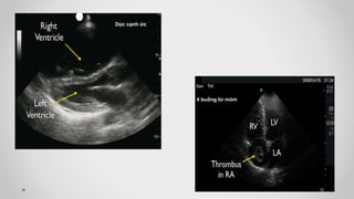 Dọc cạnh ức
4 buồng từ mỏm
 
