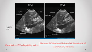 Caval Index = IVC collapsibility index =
[Maximum IVC dimension- Minimum IVC dimension] X 100
Maximum IVC dimension
Hepatic
vein
 