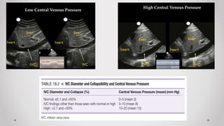 Low Central Venous Pressure
High Central Venous Pressure
 