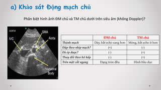 Phân biệt hình ảnh ĐM chủ và TM chủ dưới trên siêu âm (không Doppler)?
a) Khảo sát Động mạch chủ
ĐM chủ TM chủ
Thành mạch Dày, bắt echo sang hơn Mỏng, bắt echo ít hơn
Đập theo nhịp mạch? (+) (-)
Đè ép được? (-) (+)
Thay đổi theo hô hấp (-) (+)
Trên mặt cắt ngang Dạng tròn đều Hình bầu dục
 