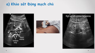 a) Khảo sát Động mạch chủ
 