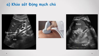 a) Khảo sát Động mạch chủ
 