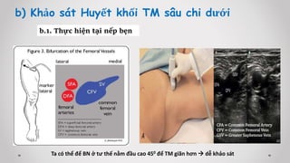b) Khảo sát Huyết khối TM sâu chi dưới
b.1. Thực hiện tại nếp bẹn
CFA = Common Femoral Artery
CFV = Common Femoral Vein
GSV = Greater Saphenous Vein
Ta có thể để BN ở tư thế nằm đầu cao 450 để TM giãn hơn  dễ khảo sát
 