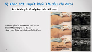 b) Khảo sát Huyết khối TM sâu chi dưới
b.2. Di chuyển từ nếp bẹn đến hố khoeo
- Ta di chuyển đầu dò ra xa đến chỗ chia đôi
thành TM đùi nông và TM đùi sâu
- Lưu ý: nên đè ép ở vị trí cách chỗ chia # 5cm
SFA = Superficial Femoral Artery
DFA = Deep Femoral Vein
SFV = Superficial Femoral Vein
 