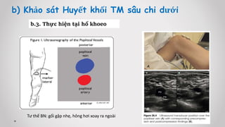 b) Khảo sát Huyết khối TM sâu chi dưới
b.3. Thực hiện tại hố khoeo
Tư thế BN: gối gập nhẹ, hông hơi xoay ra ngoài
 