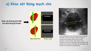a) Khảo sát Động mạch chủ
Khảo sát đường kính ĐM
chủ phải đúng kỹ thuật!
Some abdominal aortic aneurysms may contain
thrombi. Careful attention must be made to
include the thombus (blue arrow) in the
diameter measurement. The yellow arrow
indicates the correct diameter measurement. The
orange arrow does not include the thrombus and
hence is an incorrect measurement
 