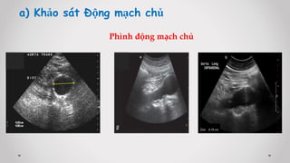 a) Khảo sát Động mạch chủ
Phình động mạch chủ
 