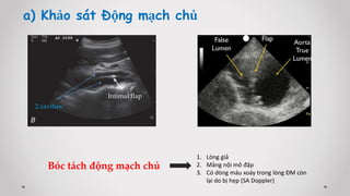 a) Khảo sát Động mạch chủ
Intimal flap
2 cavities
Bóc tách động mạch chủ
1. Lòng giả
2. Mảng nội mô đập
3. Có dòng máu xoáy trong lòng ĐM còn
lại do bị hẹp (SA Doppler)
 