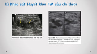 b) Khảo sát Huyết khối TM sâu chi dưới
 