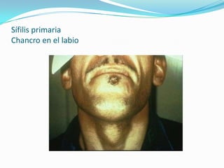 Sífilis primaria
Chancro en el labio
 