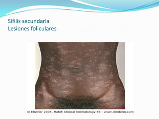 Sífilis secundaria
Lesiones foliculares
 